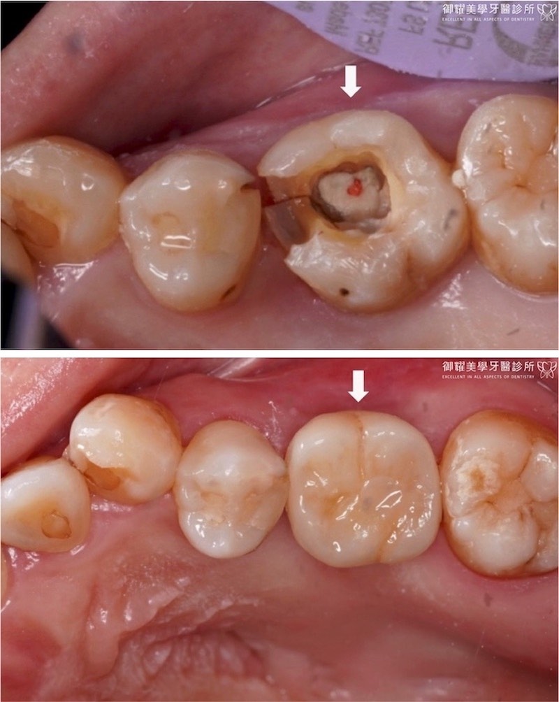 上顎臼齒拔牙後植牙，全瓷冠假牙有真牙般的細節紋理