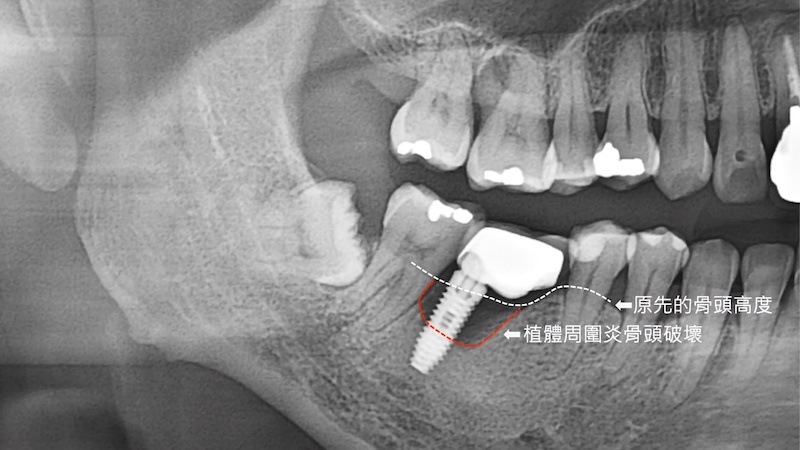 植牙後產生植體周圍炎的X光片，植體周圍的骨頭被破壞後比原先骨頭高度低