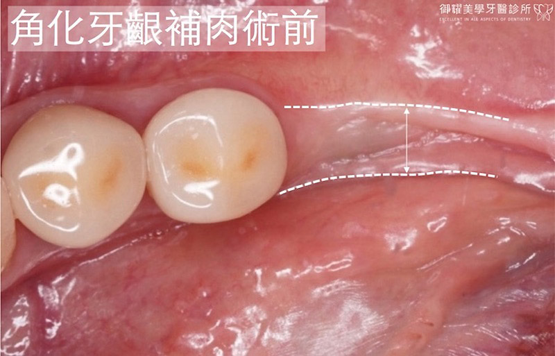 植牙補肉前的口腔近照，因長期缺牙導致齒槽骨和牙齦萎縮嚴重