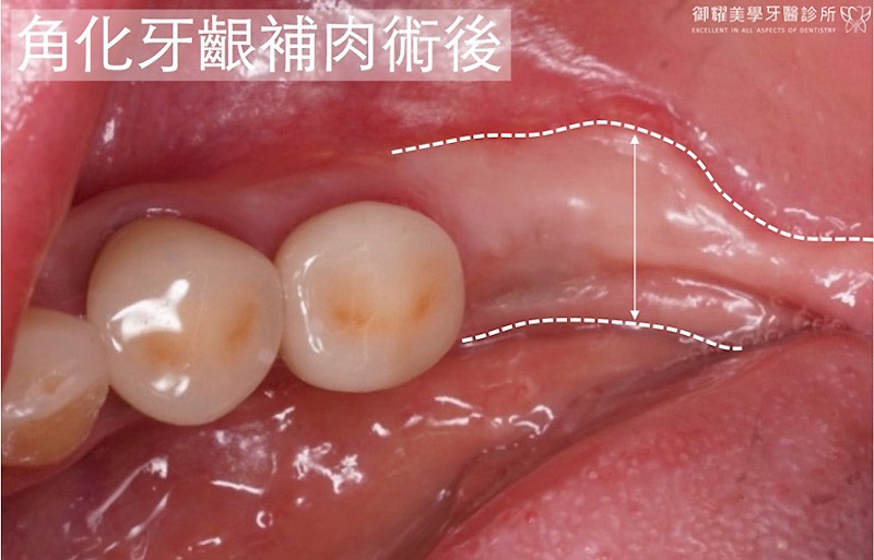 植牙補肉後的口腔近照，角化牙齦明顯增寬
