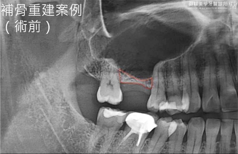 上顎植牙補骨粉前的局部X光照，缺牙處齒槽骨被吸收