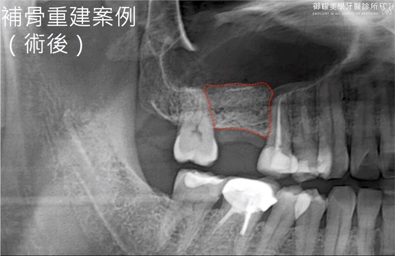 上顎植牙補骨粉後的局部X光照，骨頭厚度明顯增加