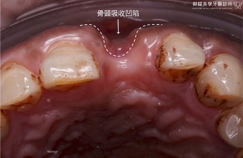 上顎植牙補骨粉前的口腔近照，因牙周病缺牙導致骨吸收凹陷