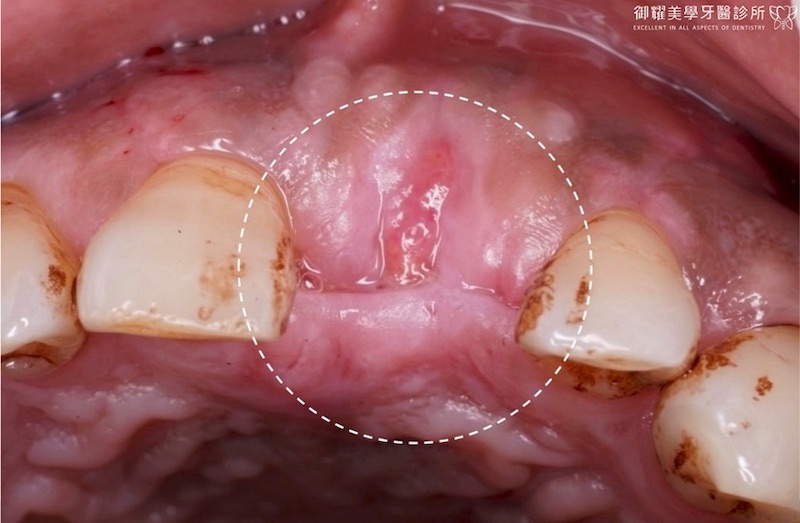 上顎植牙補骨粉後的口腔近照，已填補缺損處的骨頭