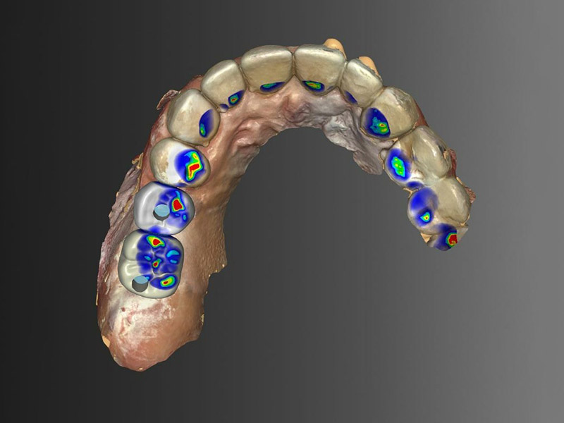 採電腦分析的植牙假牙設計圖