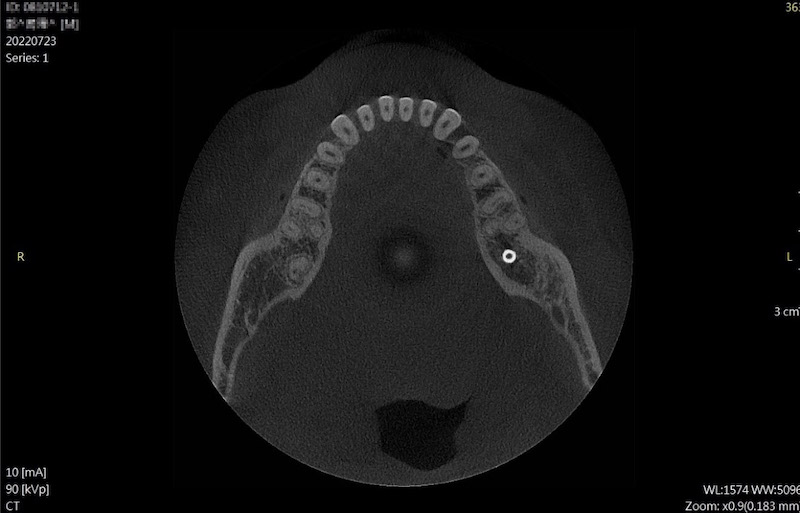 植牙後的斷層掃描影像，人工牙根被骨頭360度完整包覆