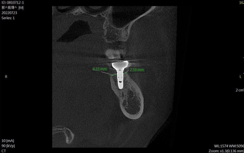 植牙後的斷層掃描影像，包覆人工牙根的骨頭厚度最大為4.33mm、最小為2.59mm，符合大部分研究標準（厚度至少1.8mm以上）