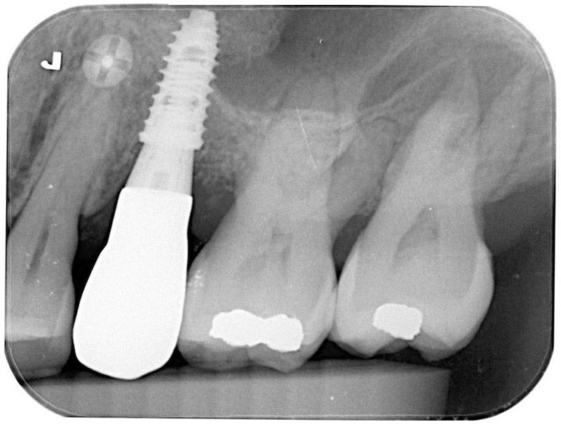 植牙後的根尖X光片，骨頭有完整包覆人工牙根