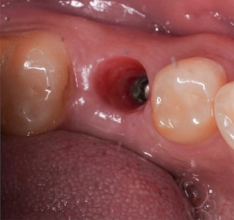 有角化牙齦的植牙成功照片，裝上假牙前可見角化牙齦完全包覆植體