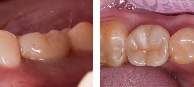 有角化牙齦的植牙成功照片，裝上假牙後的牙齦外觀狀況