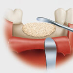 植牙補骨-補骨粉-費用-過程-成功率-植牙推薦-台中-豐原