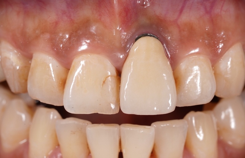 患者在他院進行門牙植牙後的咬合近照，因沒做好補骨導致植體外露