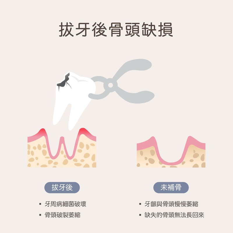 植牙補骨原因1：拔牙後未補骨會使骨頭缺損萎縮，缺失的骨頭無法長回來