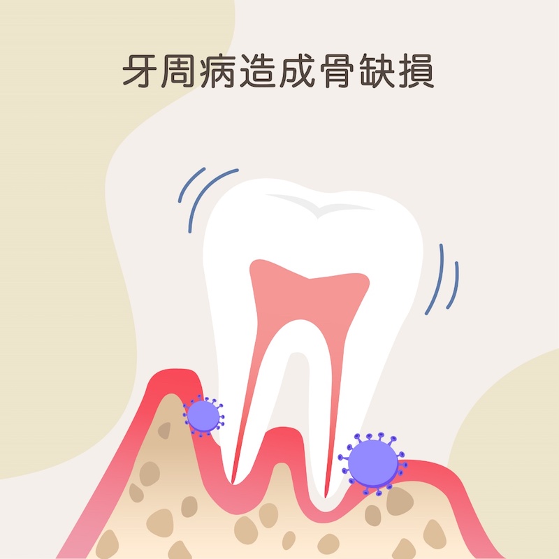 植牙補骨原因2：嚴重牙周病造成骨缺損、牙齒搖晃