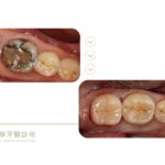蛀牙-牙齒斷裂-植牙-全瓷冠假牙-台中神岡-推薦-御耀美學牙醫