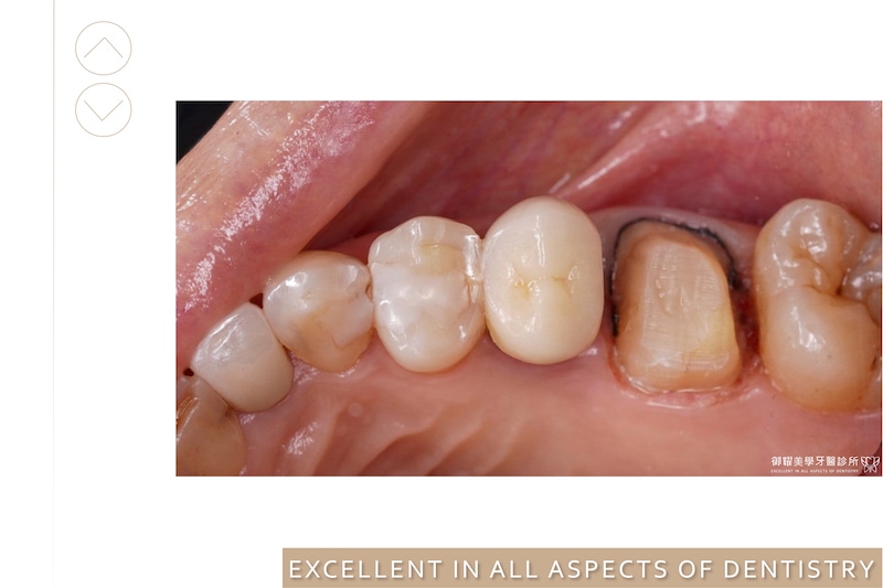 移除蛀牙後修整牙齒放入排齦線，以獲得更佳電腦取像來製作精密假牙