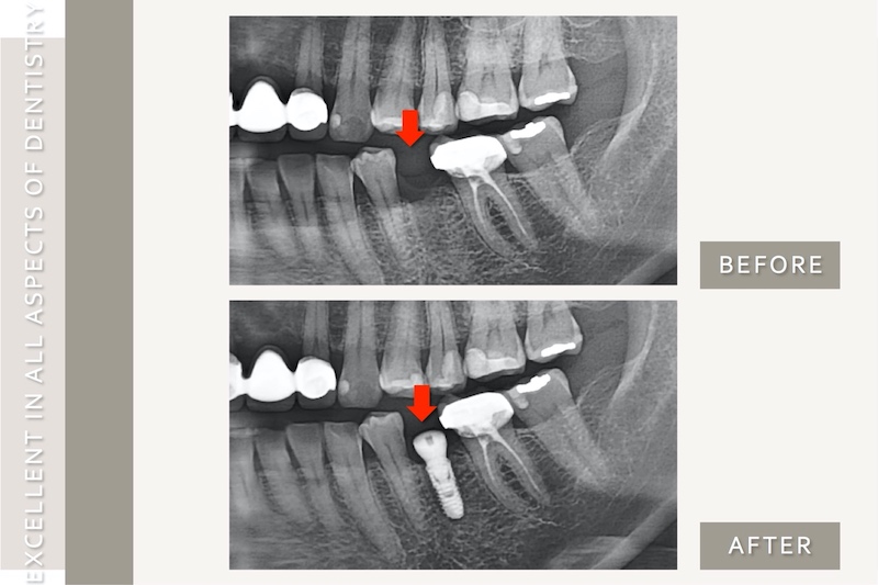 拔掉左下斷裂的牙齒進行齒槽骨保存術，術後兩個月X光片無看出有額外的骨吸收，採微創植牙治療前後的X光片對比