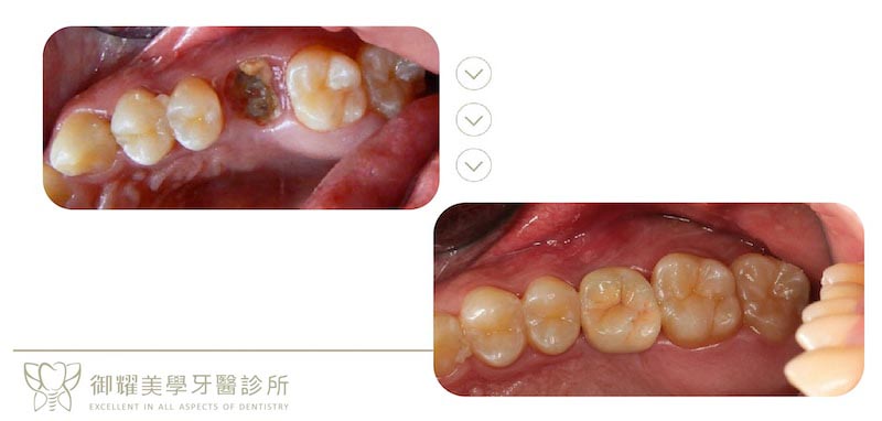 蛀牙-根管治療未做假牙牙套-牙齒斷裂-牙齦發炎-植牙-治療前後對比-推薦案例-御耀美學牙醫-台中-豐原