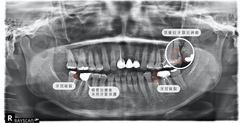 牙科治療前的環口X光片，有深層蛀牙、牙齒斷裂破損、根管治療(抽神經)後未用牙套保護等問題