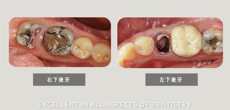 牙科治療前的左右下後牙，右下兩顆大臼齒蛀牙破損範圍大、左下後牙斷裂程度嚴重