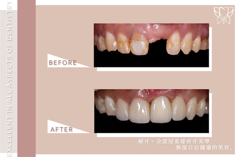 台中市北屯區患者接受門牙植牙、全瓷冠、陶瓷貼片重建前牙美觀的治療前後對比，恢復自信健康笑容