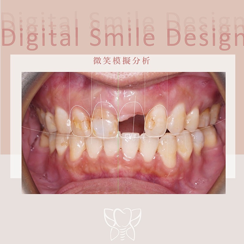 台中市北屯區患者門牙植牙前的DSD數位微笑分析，模擬上排四顆未來假牙與植牙的位置