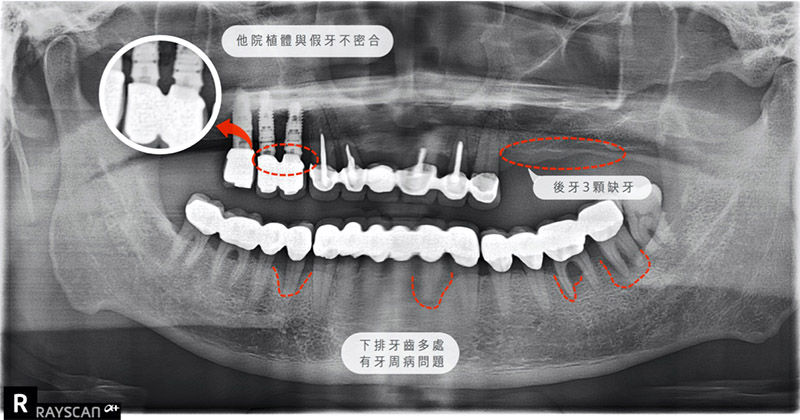后里患者植牙前X光片：除了左上3顆缺牙，口內還有他家植體與假牙不密合、牙周病等問題