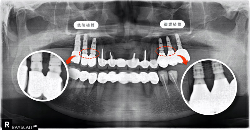 微創植牙完成後環口X光片，與他院植體相比，御耀植體與假牙密合度較佳