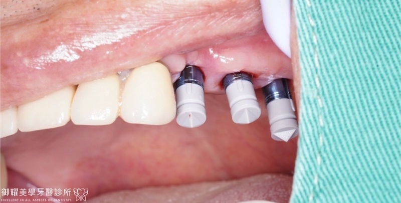 微創植牙後，透過數位口腔掃描取代不舒服的傳統印模