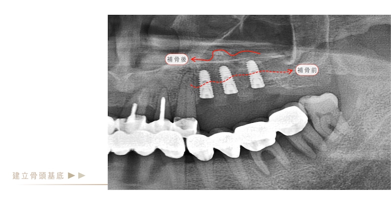 微創植牙補骨後X光片，改善植牙處補骨條件