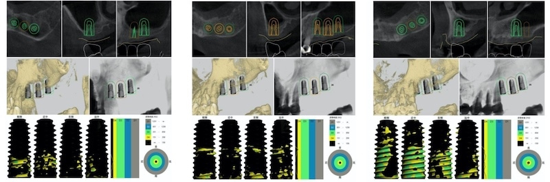 數位微創植牙電腦設計示意圖，設計植體的位置、角度、深度
