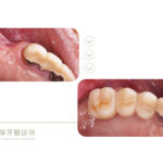 微創植牙-植牙補骨-數位植牙-豐原植牙-台中后里-推薦-御耀美學牙醫
