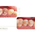 牙齒斷裂-牙根蛀牙-即拔即種-彰化-豐原植牙-台中牙醫-推薦-御耀美學牙醫