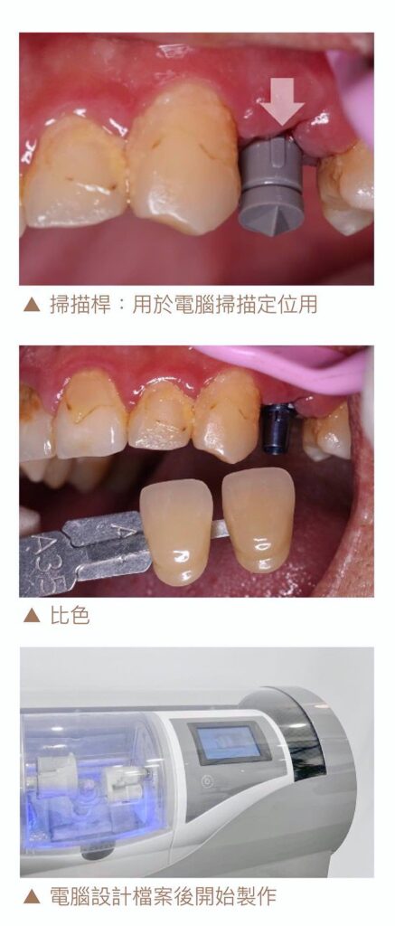 植牙假牙製作過程：採掃描桿進行電腦掃描定位、牙齒比色、設計完成後利用研磨設備製作假牙