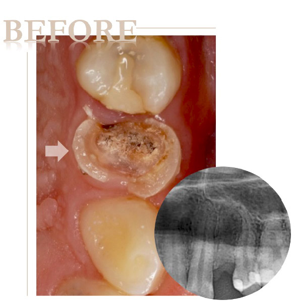牙根蛀牙嚴重導致牙齒斷裂，即拔即種植牙術前口內與X光片