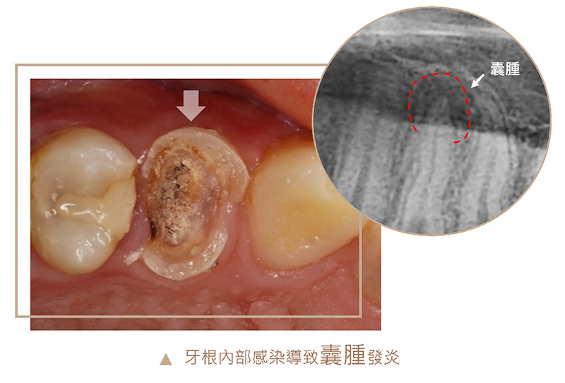 牙根蛀牙嚴重，導致內部感染發炎長出根尖囊腫