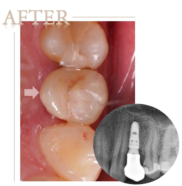 牙根蛀牙嚴重導致牙齒斷裂，即拔即種植牙術後口內與X光片