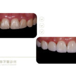 矯正牙齒-戴牙套-牙齒黃-陶瓷貼片-牙齒美白-台中-推薦-御耀美學牙醫