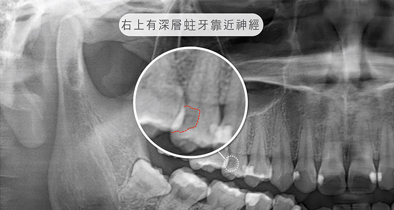 治療前X光片，右上有深層蛀牙靠近神經