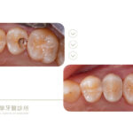 蛀牙-根管治療-一日假牙-全瓷冠-豐原-台中牙醫-推薦-御耀美學牙醫