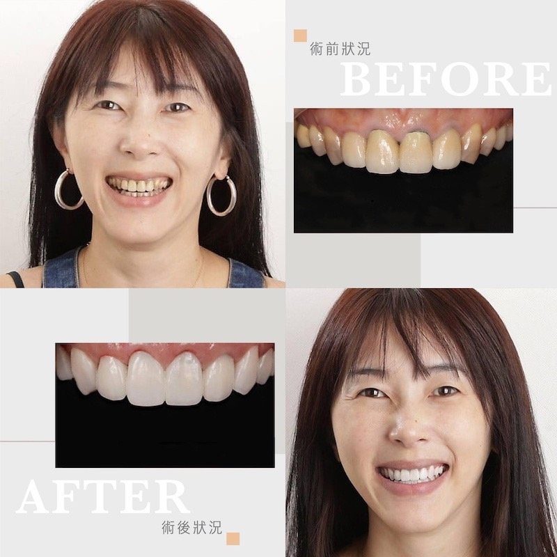 患者上排門牙假牙染色變黑，還有四環黴素染色、牙齒黃等問題；全瓷冠、陶瓷貼片治療後牙齒變得白皙自然，笑起來更美