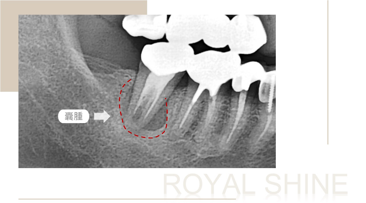 右下第二大臼齒X光片，牙根尖囊腫導致台中市后里區患者C先生在牙齒抽神經後還會痛