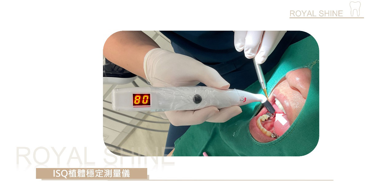 為台中市后里區C先生進行第二大臼齒植牙，植牙後使用儀器測量植體穩定度，數值超越70代表高穩定度