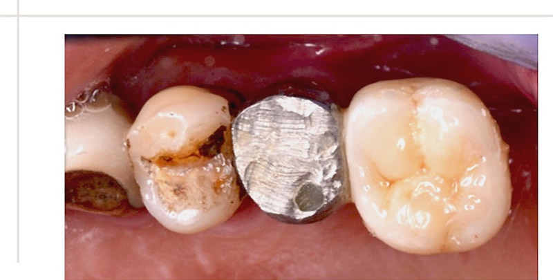 完成牙周病植牙手術，裝上細節仿真的全瓷冠假牙