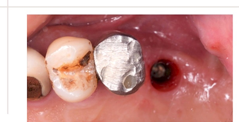 植牙部位完成補骨手術、牙肉塑形