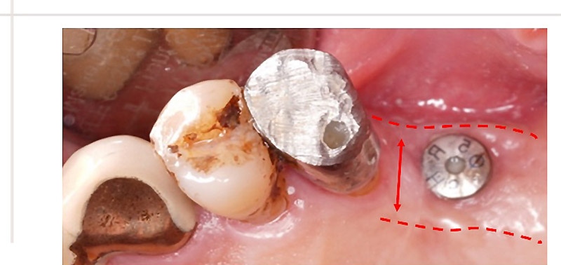植牙部位進行補骨手術後、鎖上癒合帽牙肉塑形