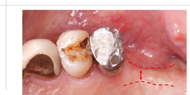 牙周病導致齒槽骨流失、骨頭寬度不足，植牙前需先補骨