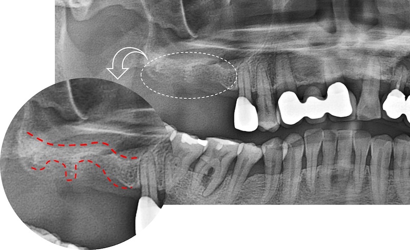 嚴重牙周病患者植牙前的X光片，齒槽骨被破壞導致骨頭高度不一