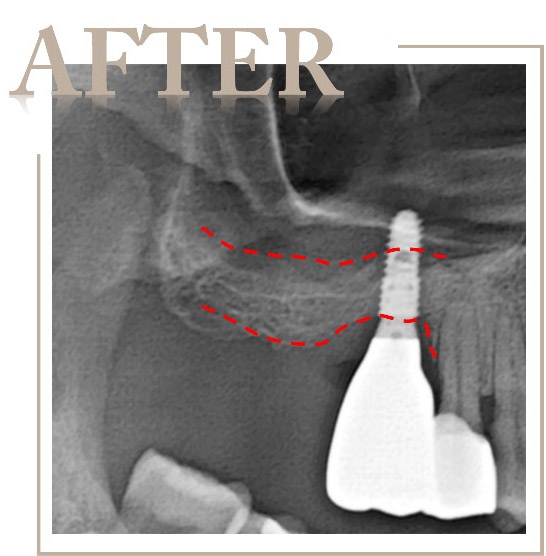 補骨後完成植牙手術，恢復齒槽骨高度與咬合