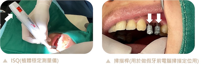 台中御耀美學牙醫的植牙流程：採ISQ(植體穩定測量儀)測量植體穩定度，並透過掃描桿進行製作植牙假牙前的電腦掃描定位